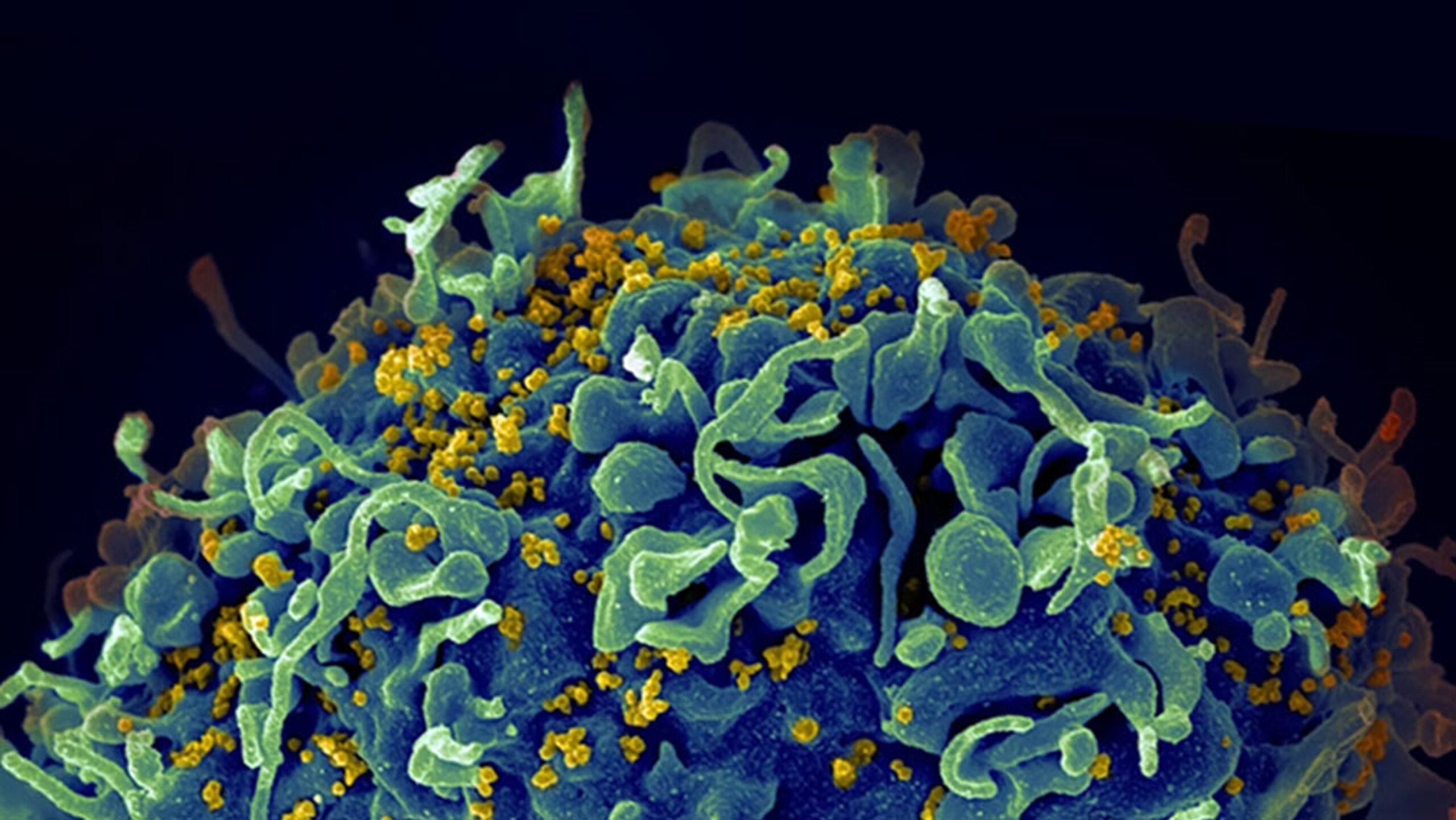 HIV, the AIDS virus, infecting a human cell