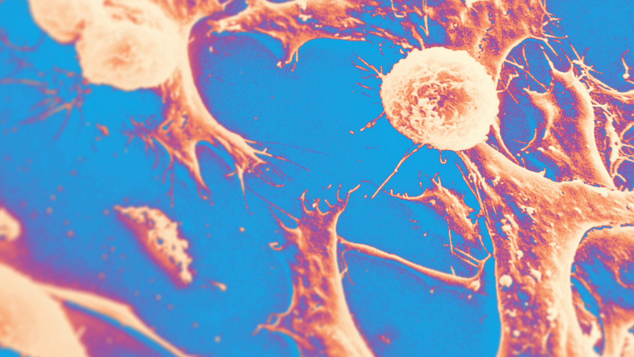 recolored electron micrograph of Wilms' tumor