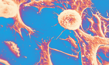 article teaser image - recolored electron micrograph of Wilms' tumor